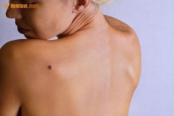 Nam giới hay phụ nữ có nốt ruồi sau vai trái đều không tốt