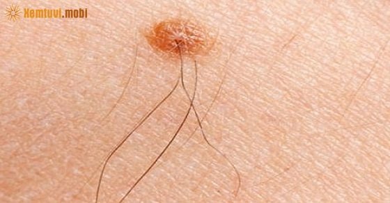 Xem tướng nốt ruồi có lông, mọc lông trên cơ thể